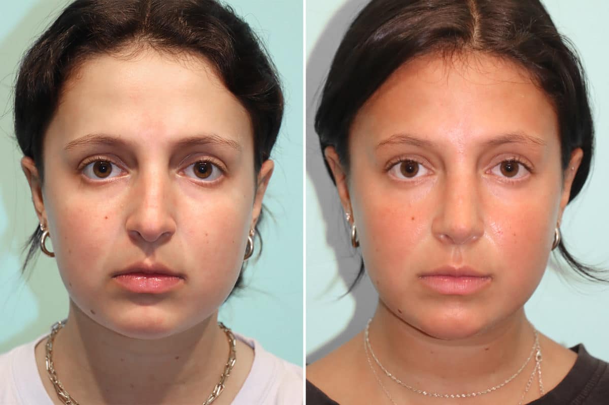 Before and after Rhinoplasty by Dr. Shervin Naderi, Patient 24476