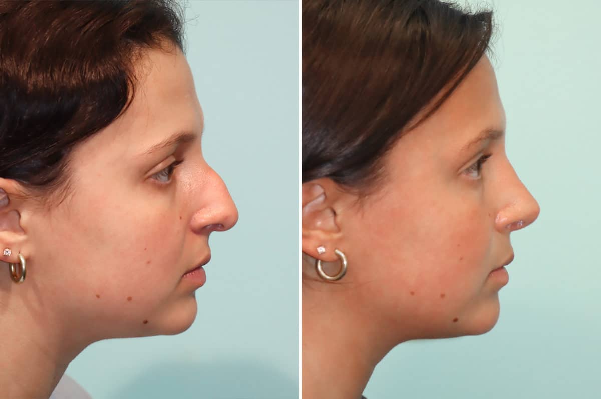 Before and after Rhinoplasty by Dr. Shervin Naderi, Patient 24476