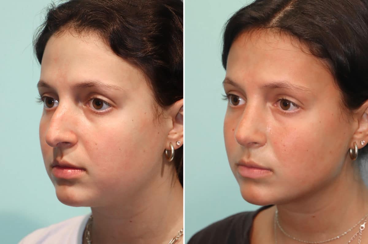 Before and after Rhinoplasty by Dr. Shervin Naderi, Patient 24476