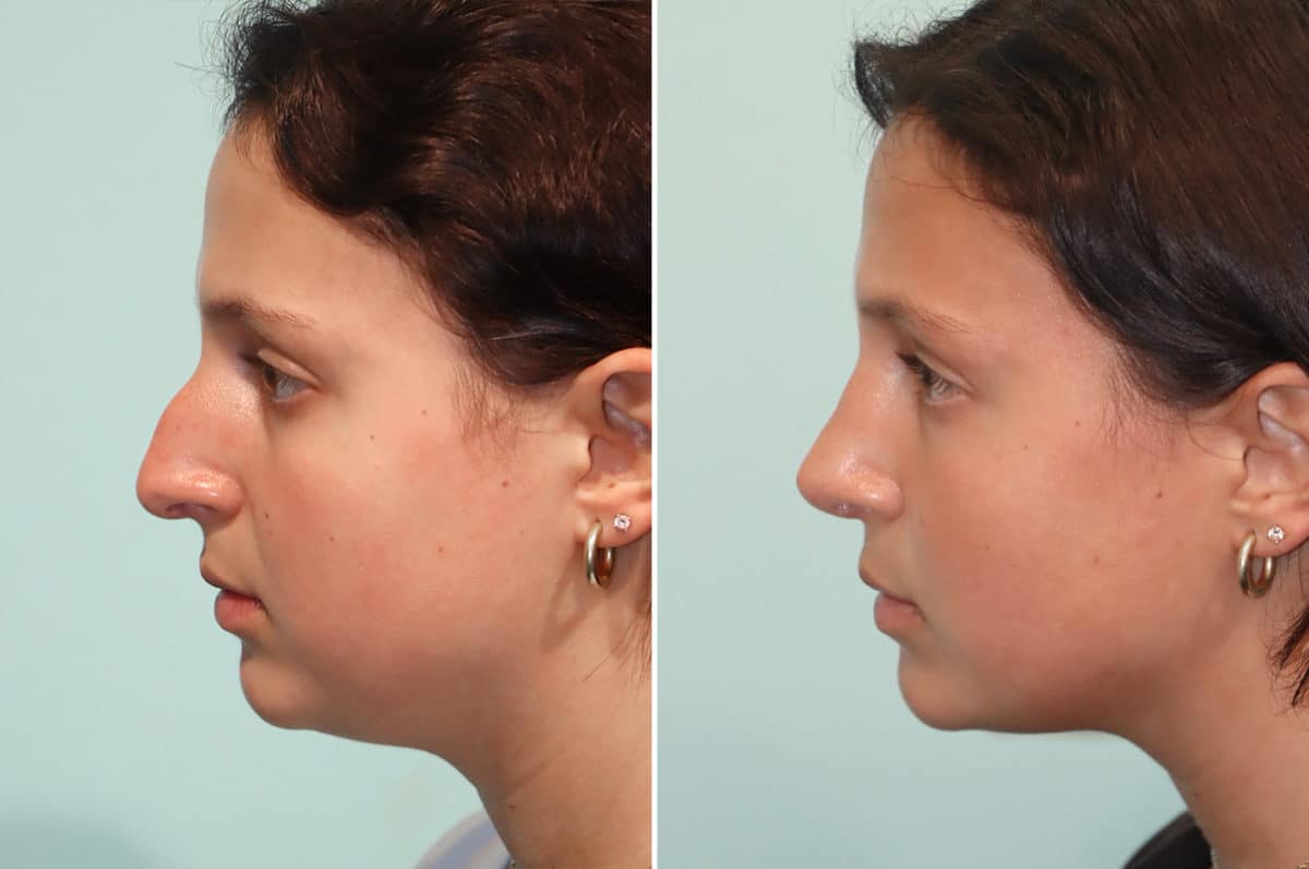 Before and after Rhinoplasty by Dr. Shervin Naderi, Patient 24476