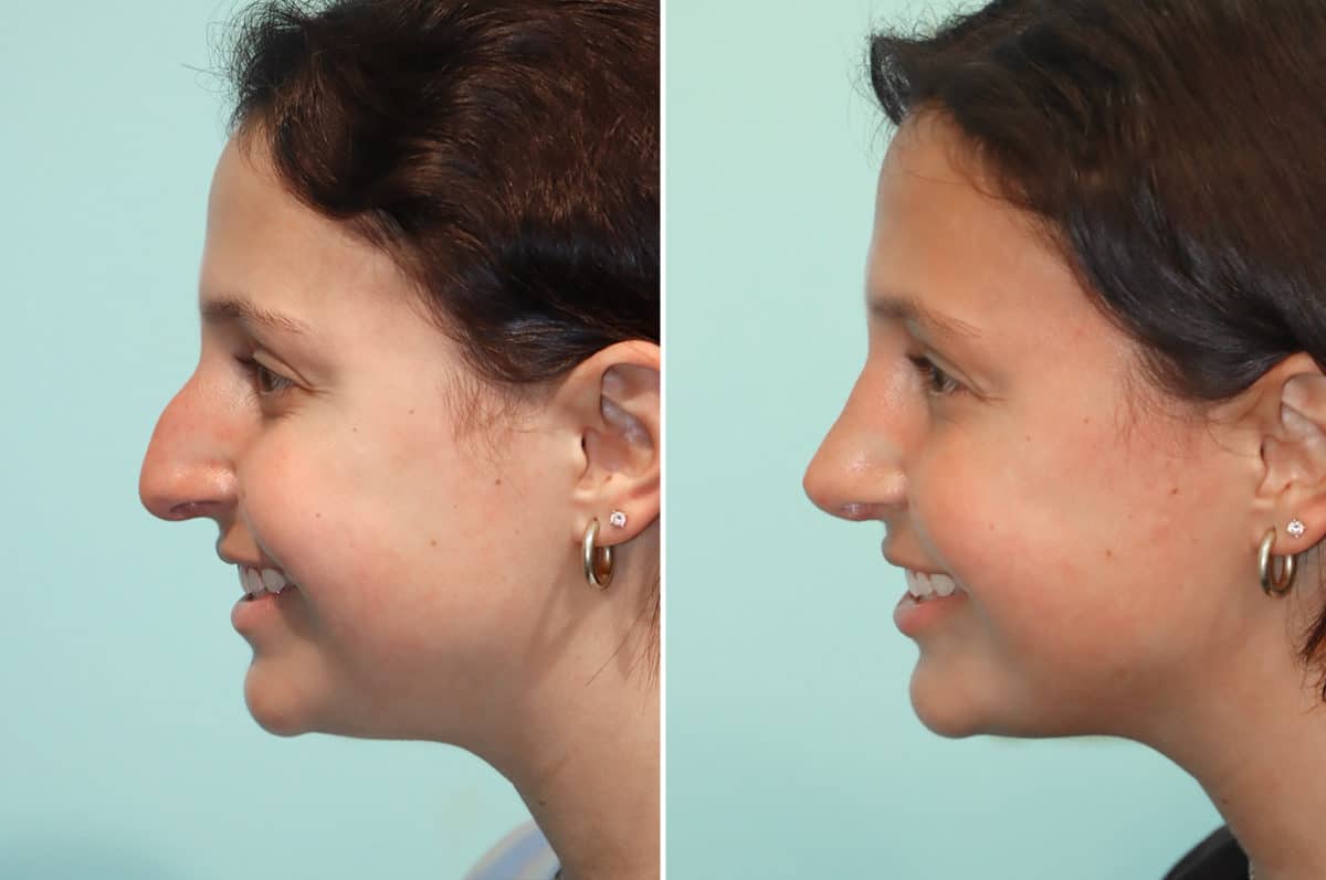 Before and after Rhinoplasty by Dr. Shervin Naderi, Patient 24476