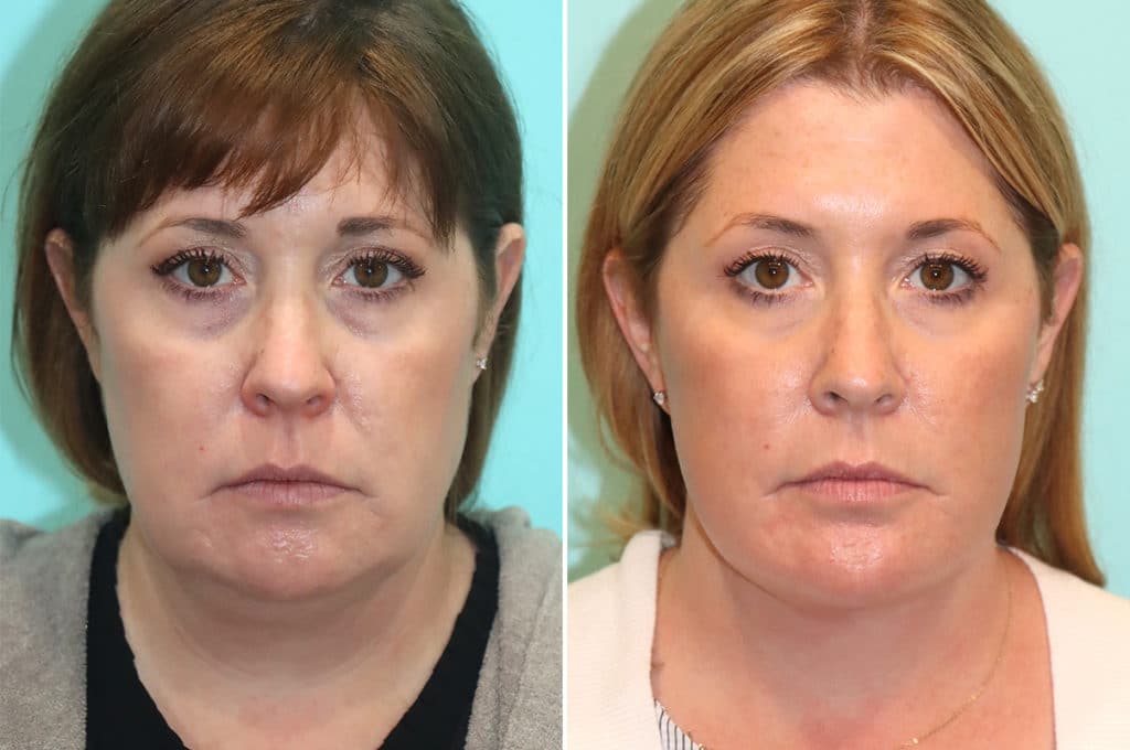Chin & Facial Implant, Facelift, Fat Transfer photos Chevy Chase, MD