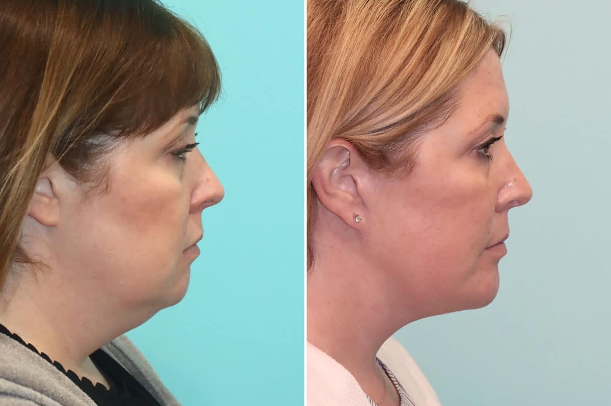 Before and after Chin & Facial Implant by Dr. Shervin Naderi, Patient 24496