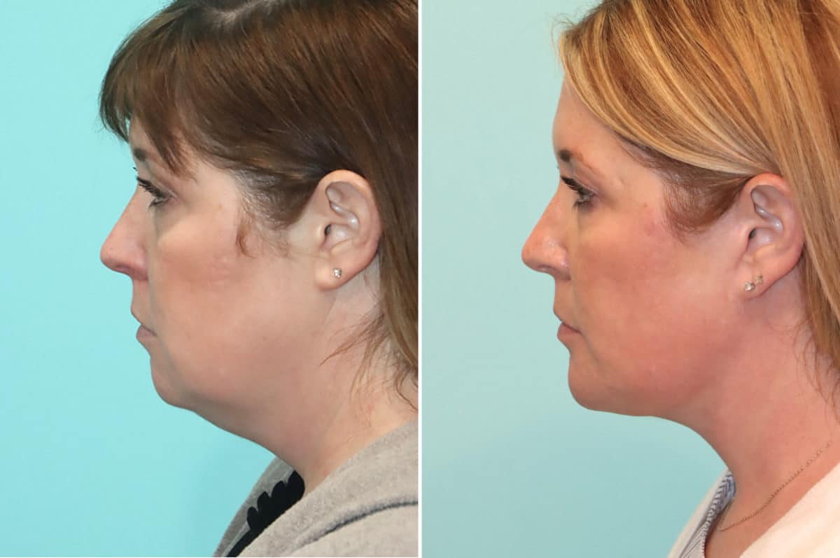 Before and after Chin & Facial Implant by Dr. Shervin Naderi, Patient 24496