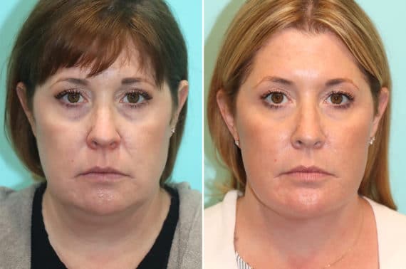 Facelift before and after photos - The Naderi Center for Plastic Surgery &  Dermatology