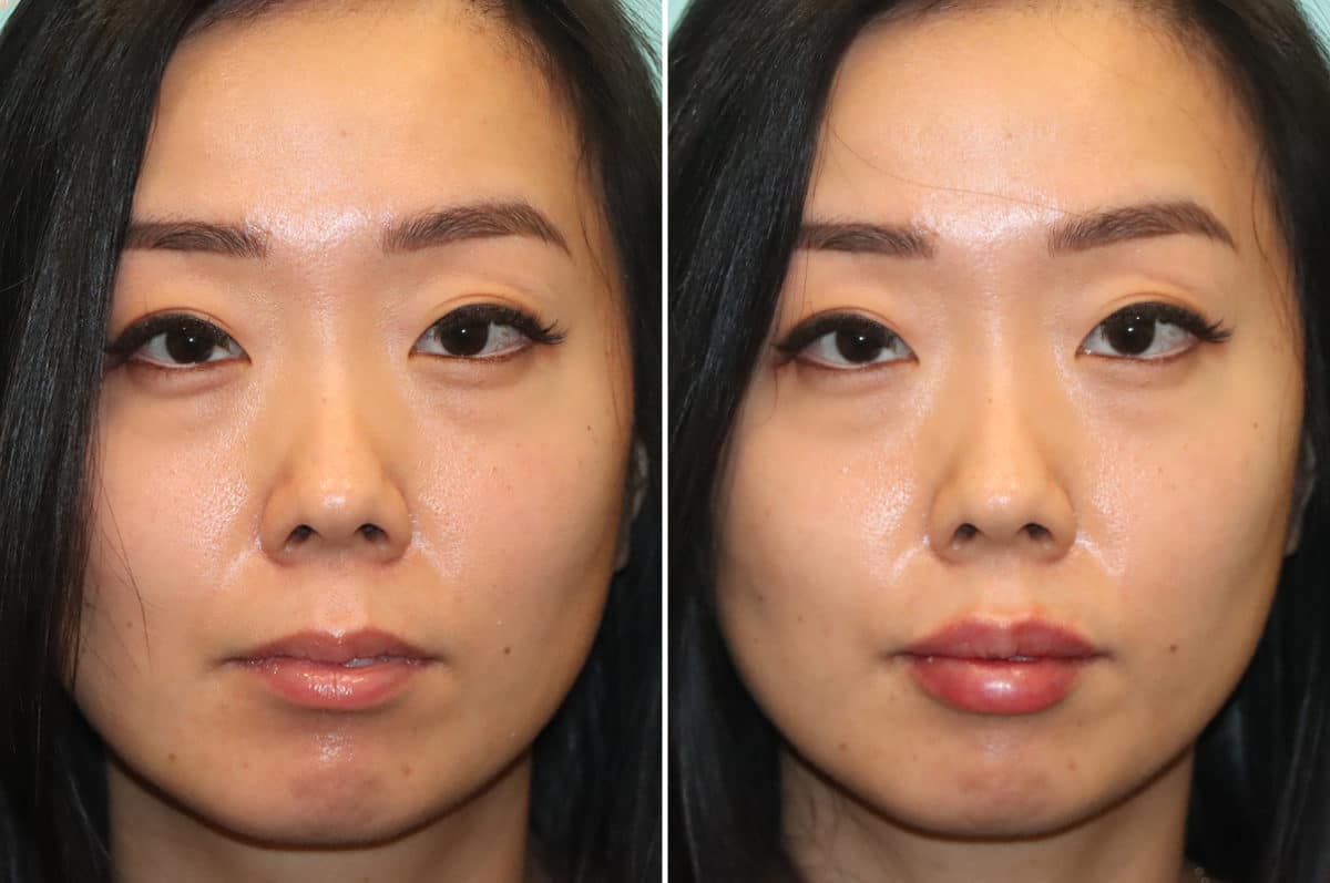 Before and after Lip Augmentation by Dr. Shervin Naderi, Patient 24512