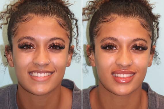 Before and after Lip Augmentation by Dr. Shervin Naderi, Patient 24516