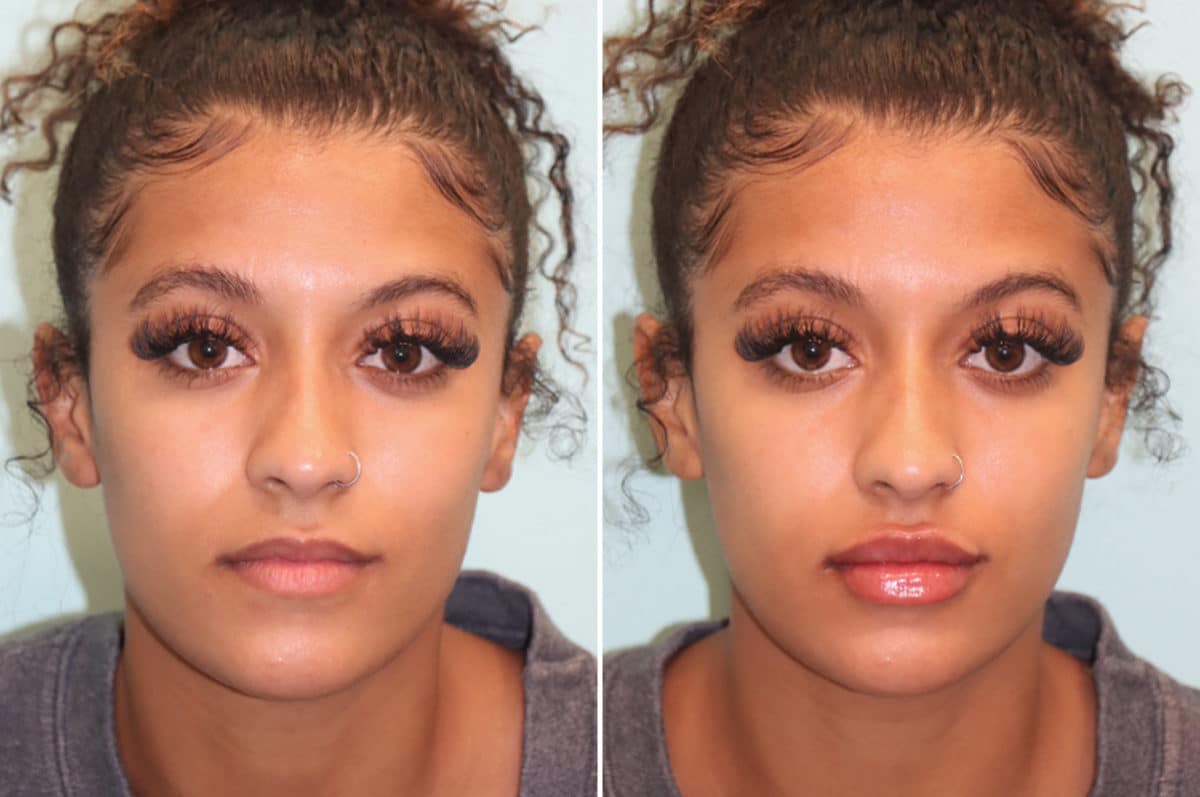 Before and after Lip Augmentation by Dr. Shervin Naderi, Patient 24516