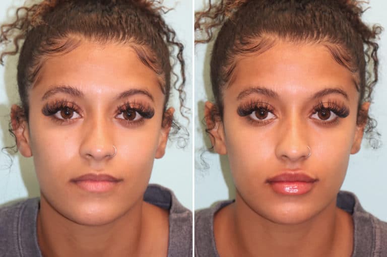 Lip Augmentation photos Chevy Chase, MD Patient 24516