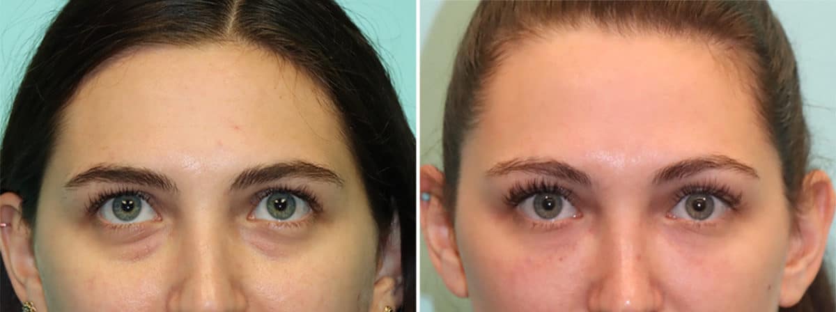 Before and after Tear Trough / Under Eye Injections by Dr. Shervin Naderi, Patient 24523