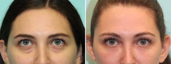 Before and after Tear Trough / Under Eye Injections by Dr. Shervin Naderi, Patient 24523