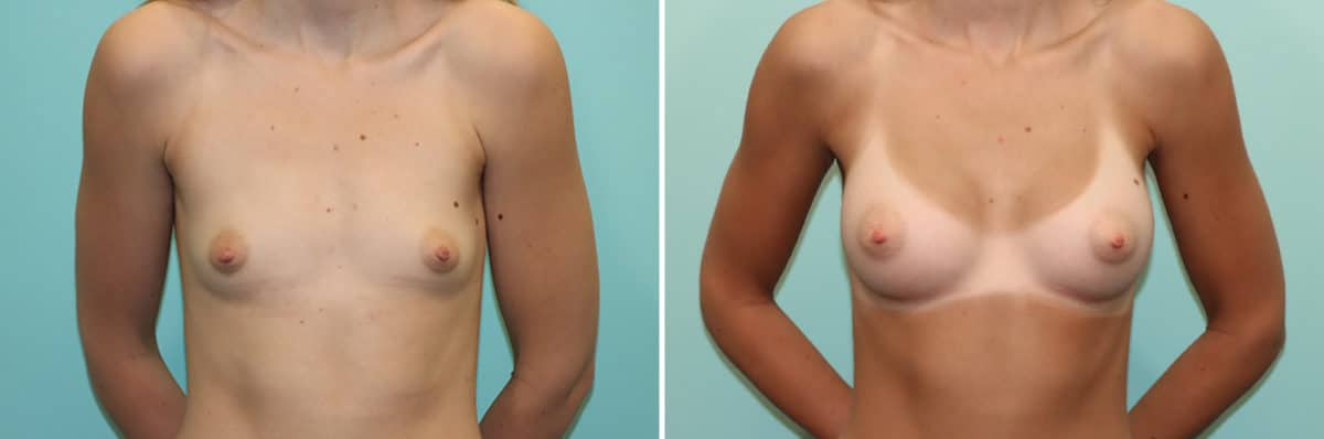 Before and after Breast Augmentation by Dr. Shervin Naderi, Patient 24527