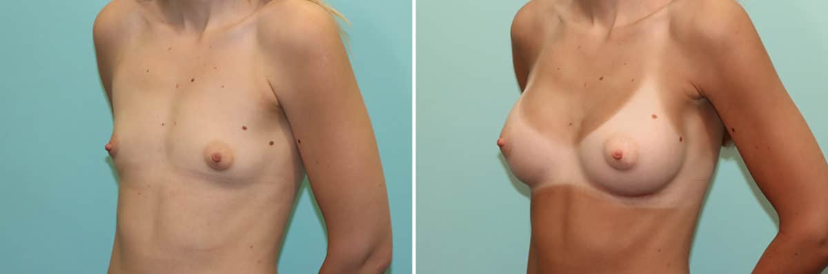 Before and after Breast Augmentation by Dr. Shervin Naderi, Patient 24527