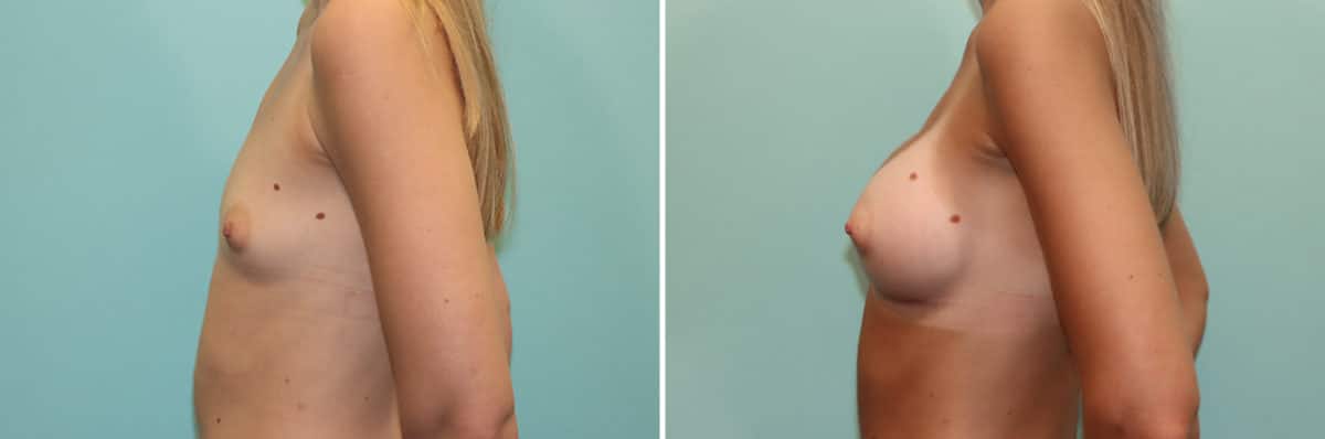 Before and after Breast Augmentation by Dr. Shervin Naderi, Patient 24527