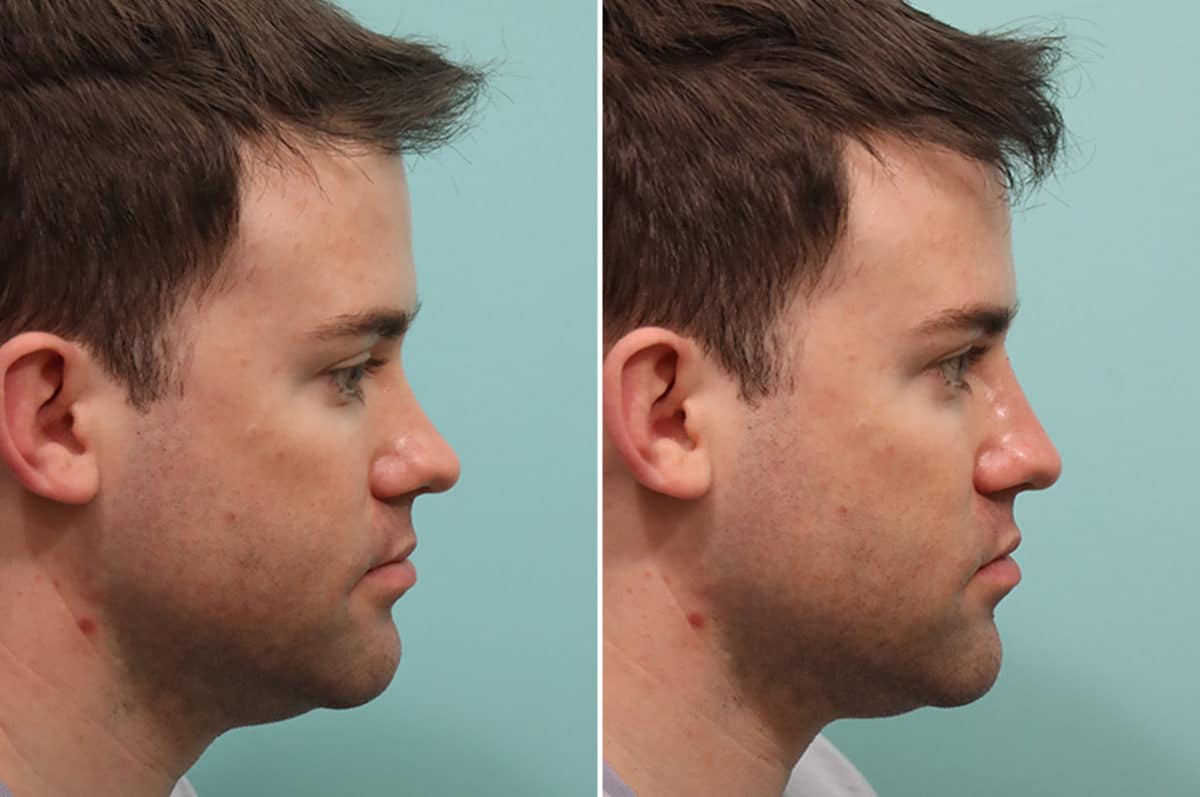 Before and after Non-Surgical Rhinoplasty by Dr. Shervin Naderi, Patient 24556