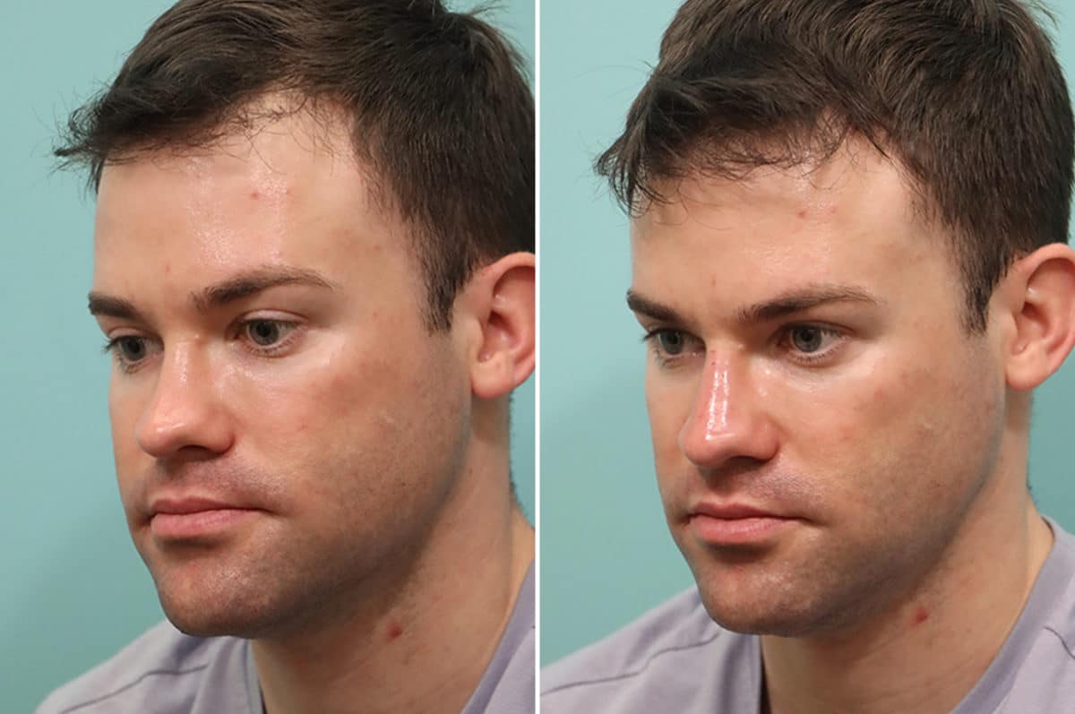 Before and after Non-Surgical Rhinoplasty by Dr. Shervin Naderi, Patient 24556