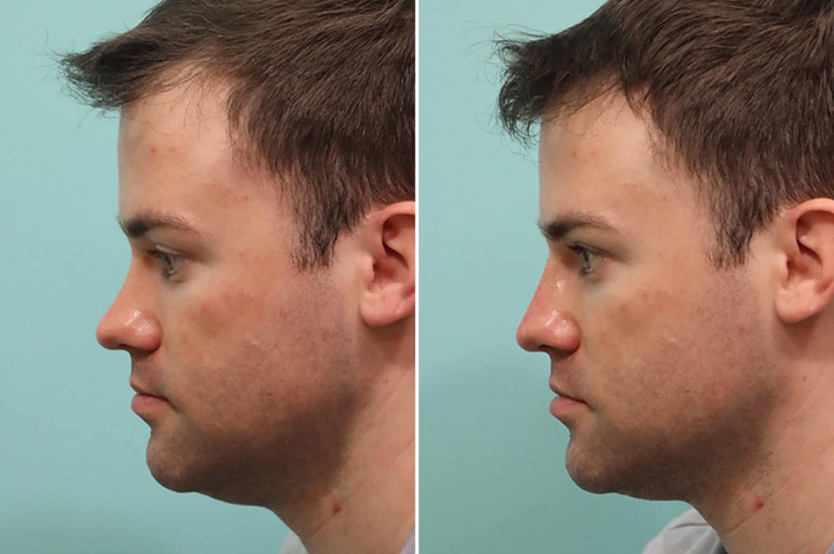 Before and after Non-Surgical Rhinoplasty by Dr. Shervin Naderi, Patient 24556