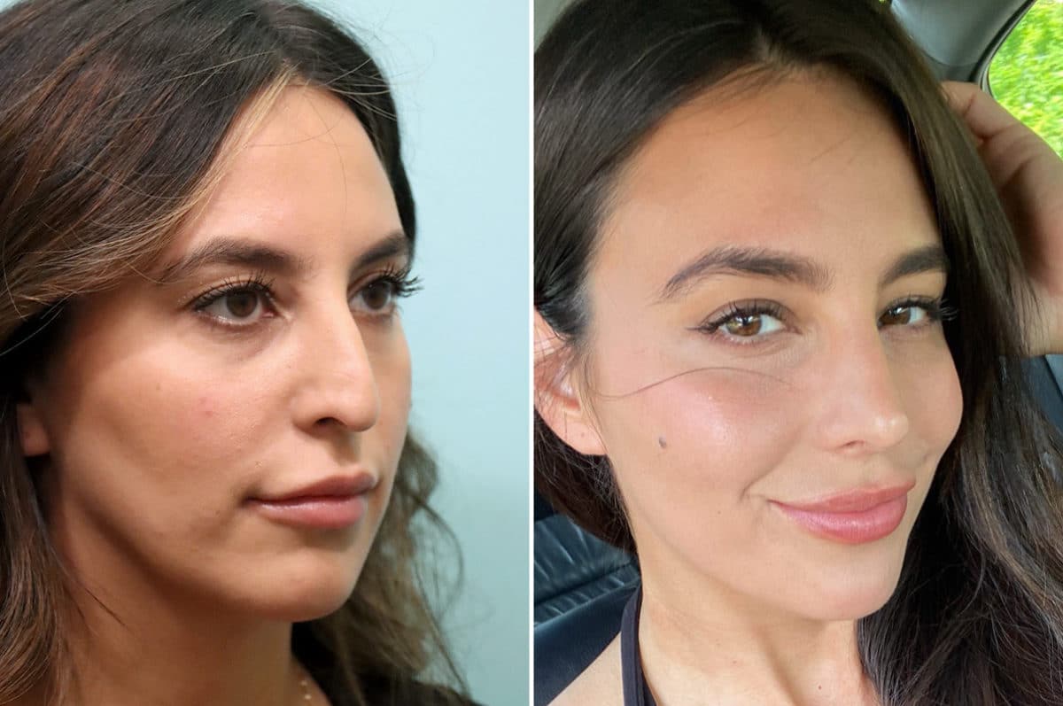 Before and after Rhinoplasty by Dr. Shervin Naderi, Patient 24573