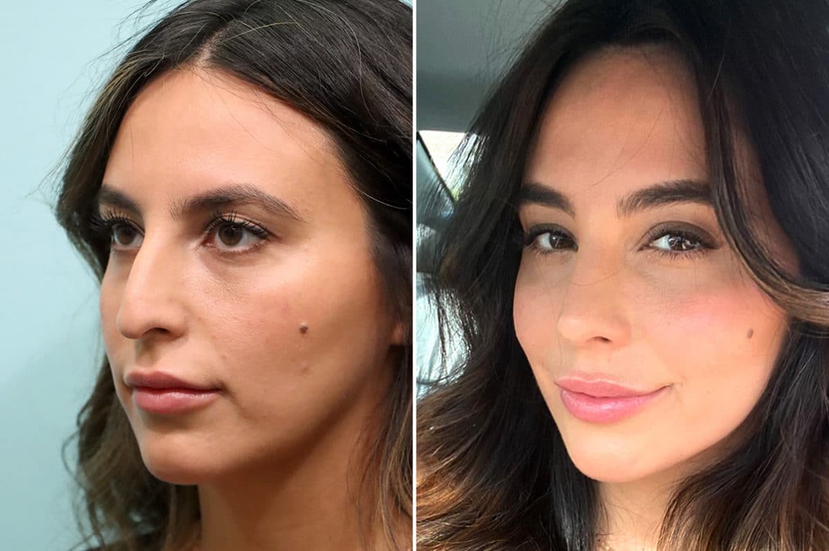 Before and after Rhinoplasty by Dr. Shervin Naderi, Patient 24573