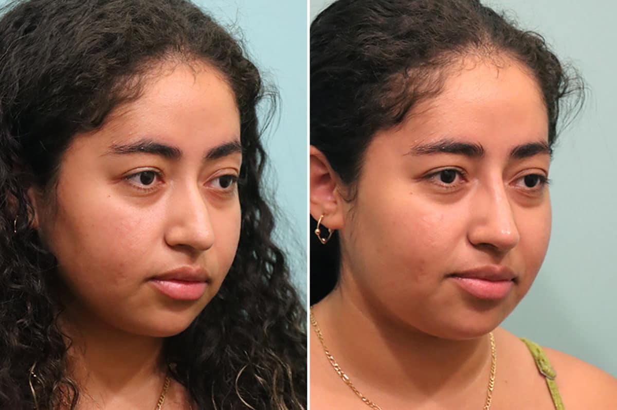 Before and after Non-Surgical Rhinoplasty by Dr. Shervin Naderi, Patient 24602