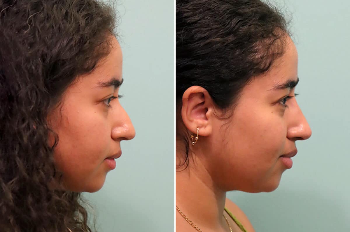 Before and after Non-Surgical Rhinoplasty by Dr. Shervin Naderi, Patient 24602