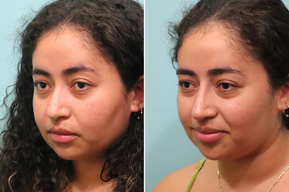 Before and after Non-Surgical Rhinoplasty by Dr. Shervin Naderi, Patient 24602