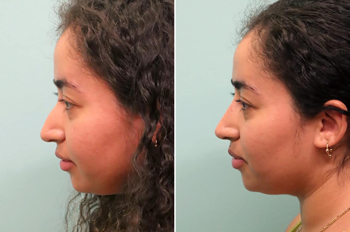 Before and after Non-Surgical Rhinoplasty by Dr. Shervin Naderi, Patient 24602