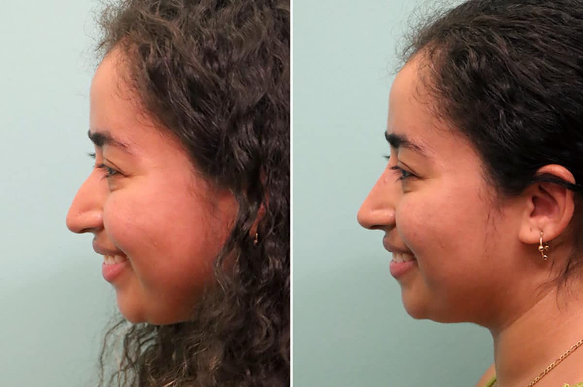 Before and after Non-Surgical Rhinoplasty by Dr. Shervin Naderi, Patient 24602