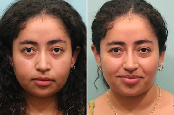 Before and after Non-Surgical Rhinoplasty by Dr. Shervin Naderi, Patient 24602