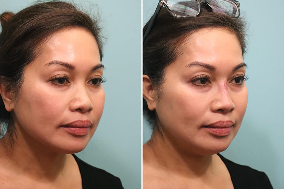 Before and after Non-Surgical Rhinoplasty by Dr. Shervin Naderi, Patient 24798