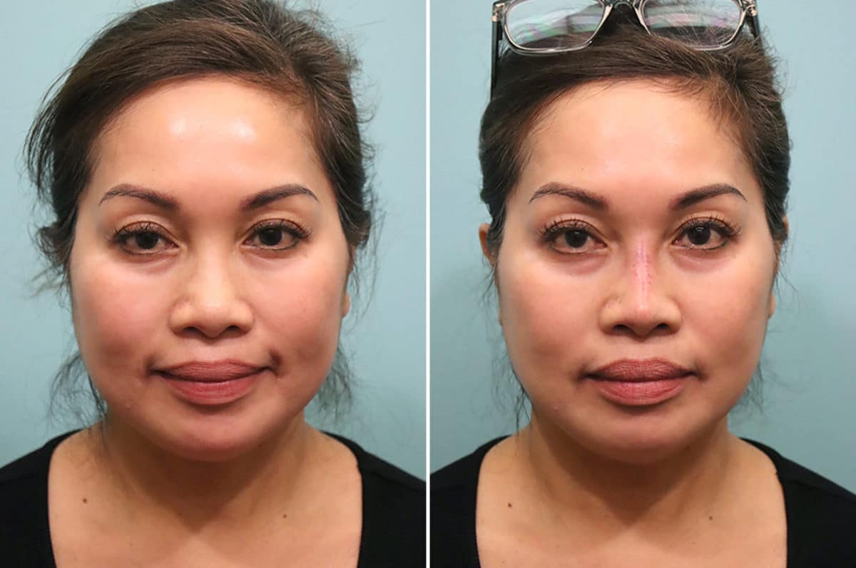 Before and after Non-Surgical Rhinoplasty by Dr. Shervin Naderi, Patient 24798