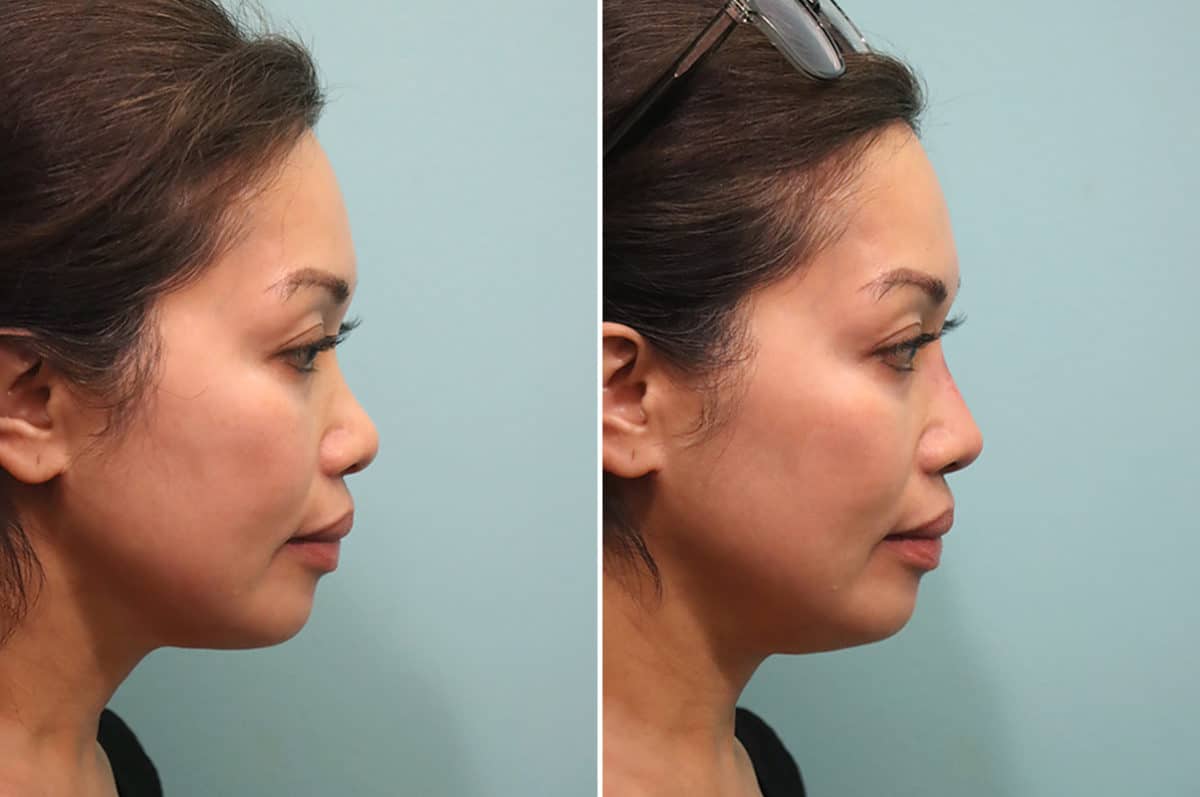 Before and after Non-Surgical Rhinoplasty by Dr. Shervin Naderi, Patient 24798