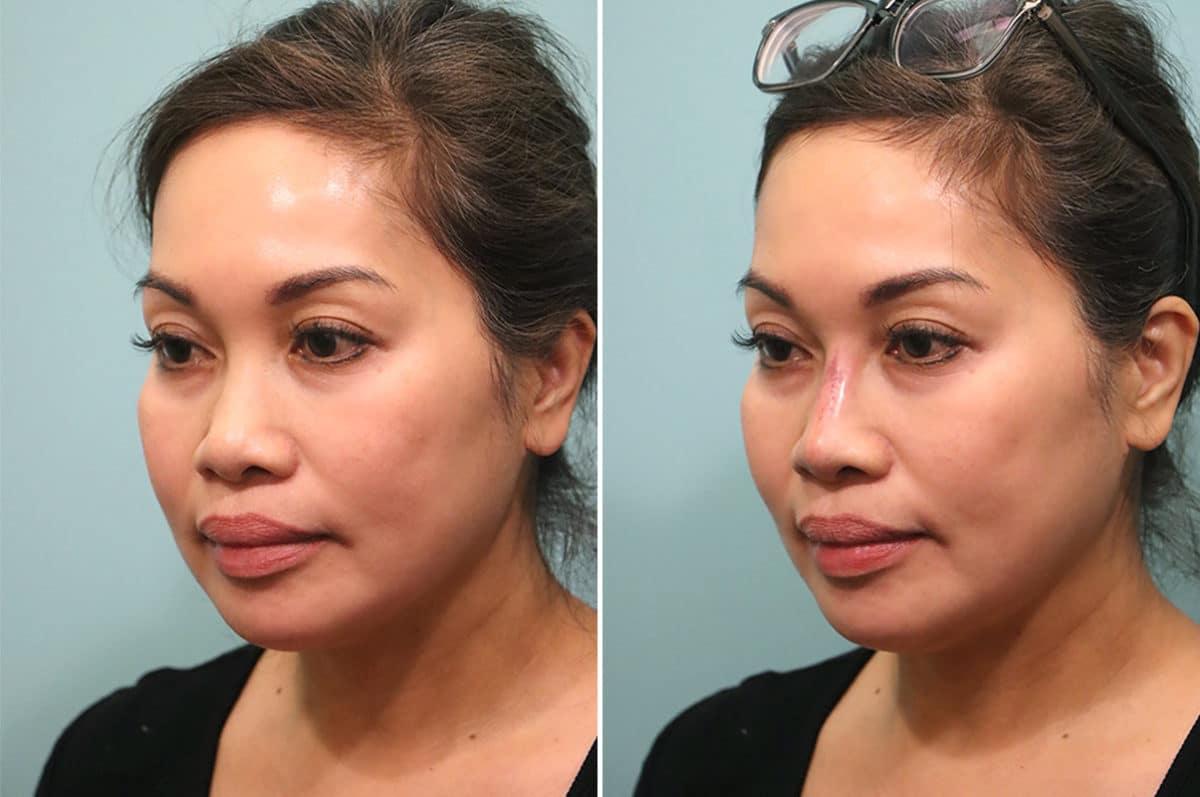 Before and after Non-Surgical Rhinoplasty by Dr. Shervin Naderi, Patient 24798