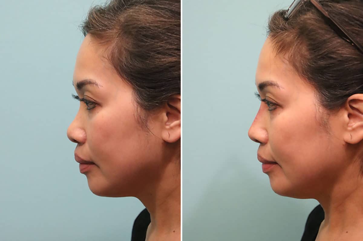 Before and after Non-Surgical Rhinoplasty by Dr. Shervin Naderi, Patient 24798