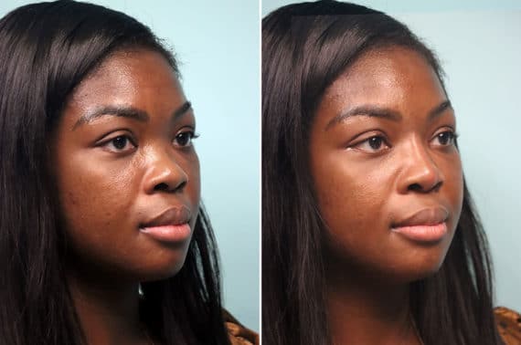 Before and after Non-Surgical Rhinoplasty by Dr. Shervin Naderi, Patient 24821