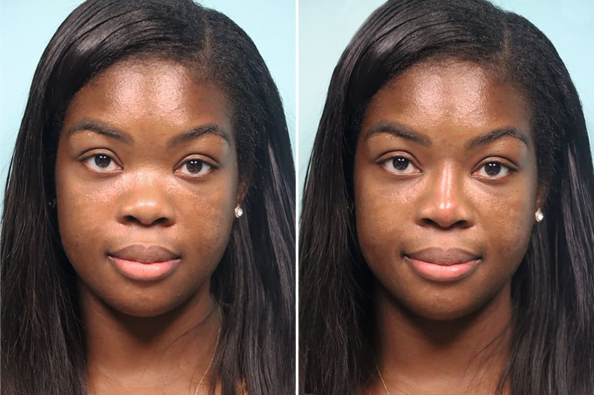 Before and after Non-Surgical Rhinoplasty by Dr. Shervin Naderi, Patient 24821