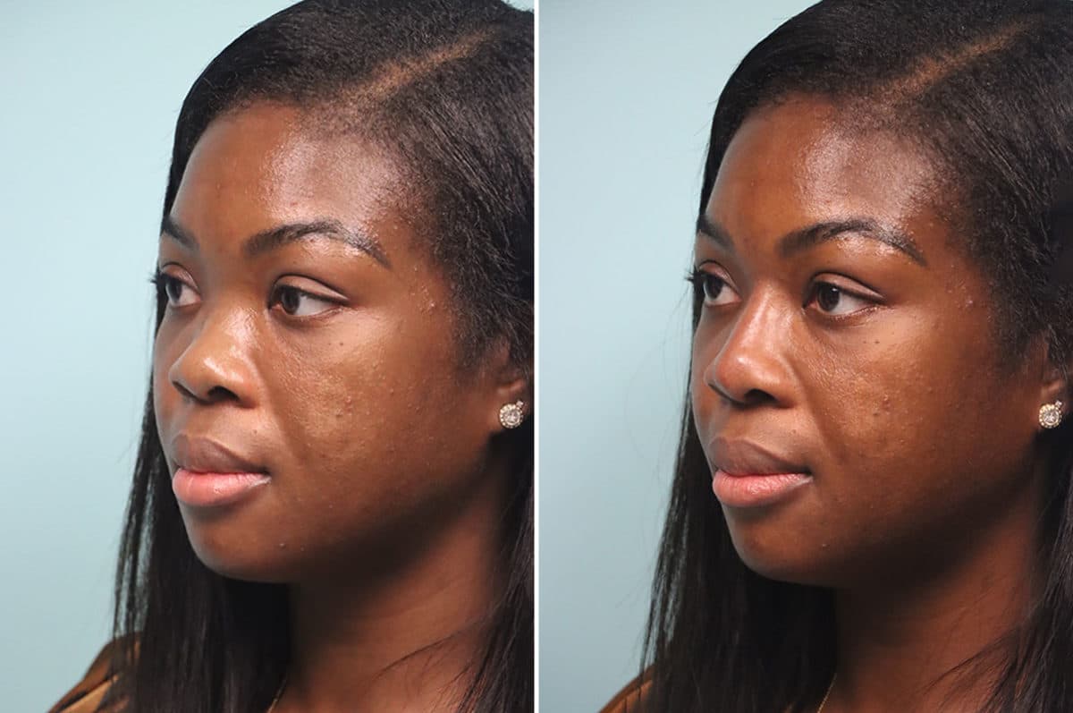 Before and after Non-Surgical Rhinoplasty by Dr. Shervin Naderi, Patient 24821