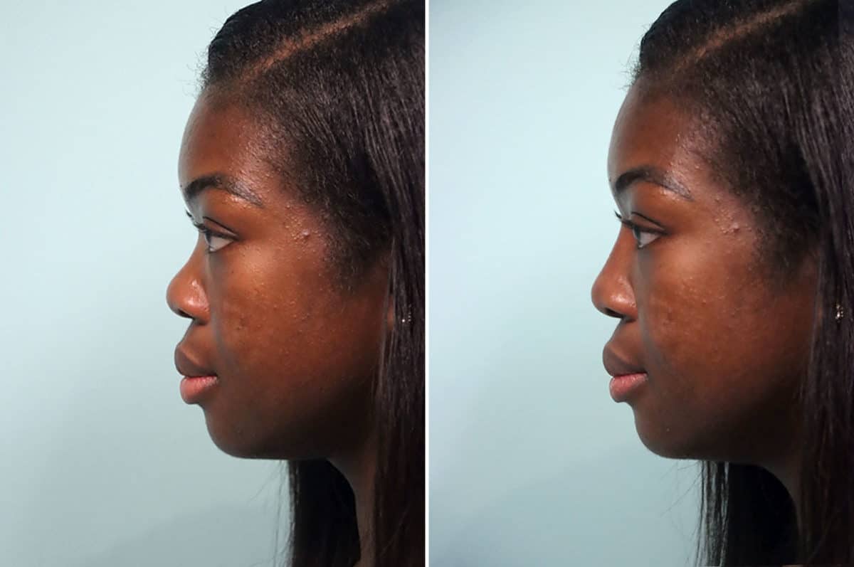 Before and after Non-Surgical Rhinoplasty by Dr. Shervin Naderi, Patient 24821