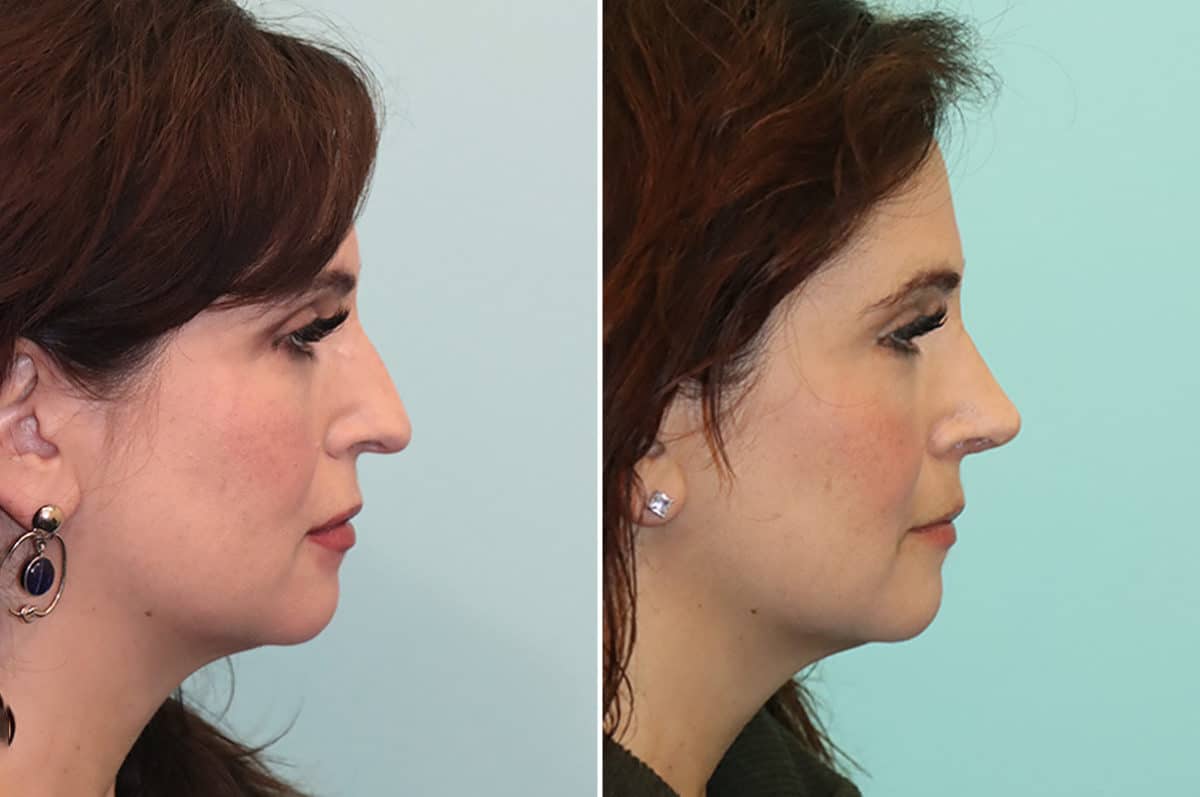 Before and after Rhinoplasty by Dr. Shervin Naderi, Patient 24822