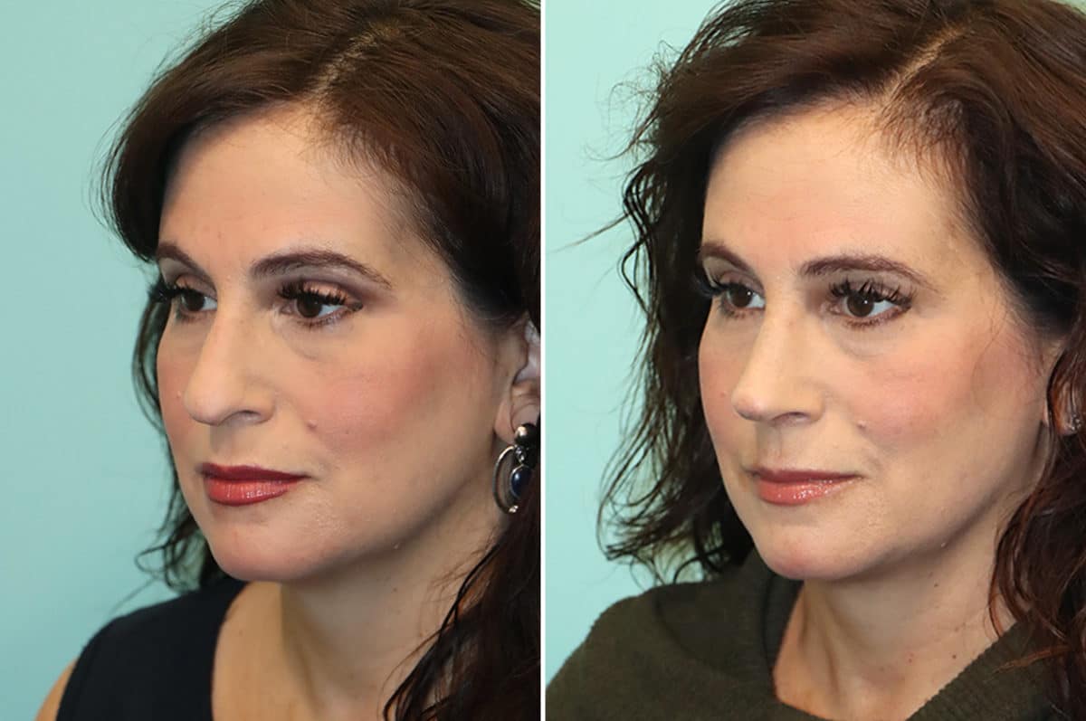 Before and after Rhinoplasty by Dr. Shervin Naderi, Patient 24822