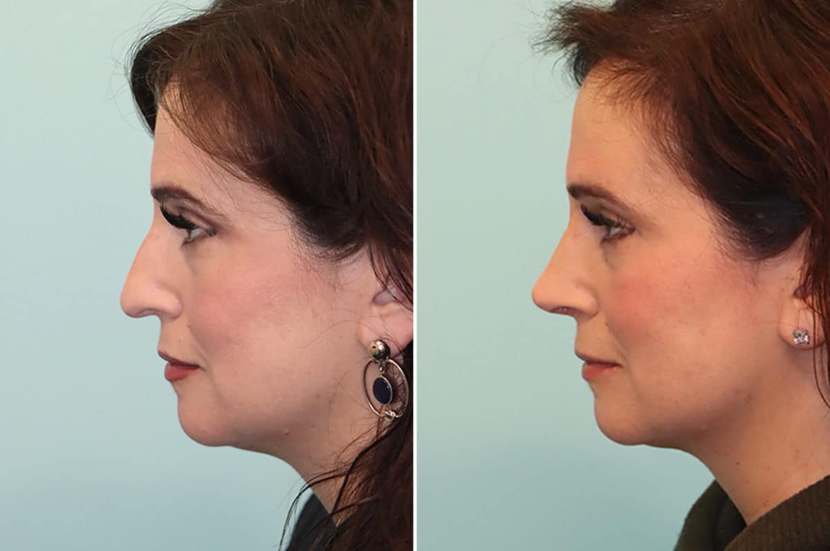 Before and after Rhinoplasty by Dr. Shervin Naderi, Patient 24822