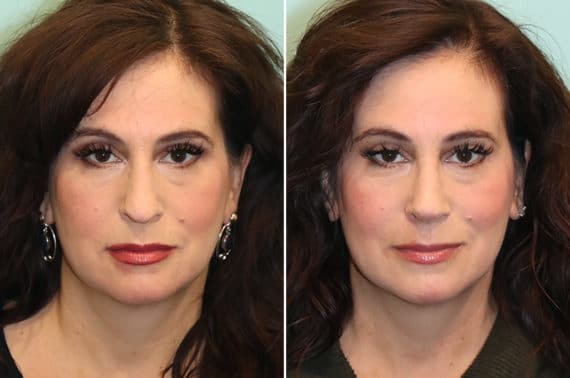 Before and after Rhinoplasty by Dr. Shervin Naderi, Patient 24822