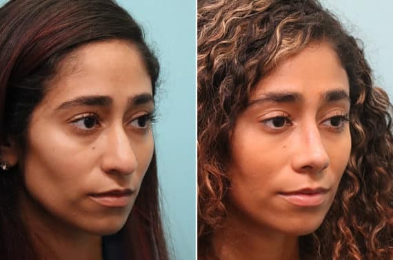 Before and after Rhinoplasty by Dr. Shervin Naderi, Patient 24851