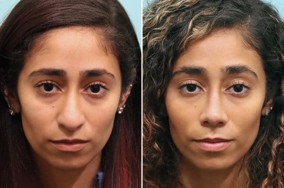 Before and after Rhinoplasty by Dr. Shervin Naderi, Patient 24851