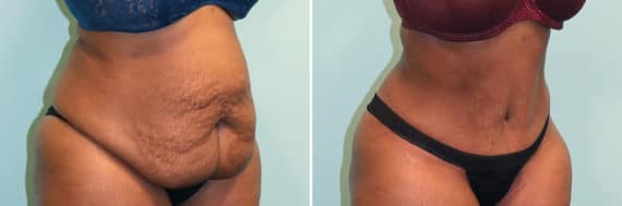 Before and after Tummy Tuck by Dr. Shervin Naderi, Patient 24870