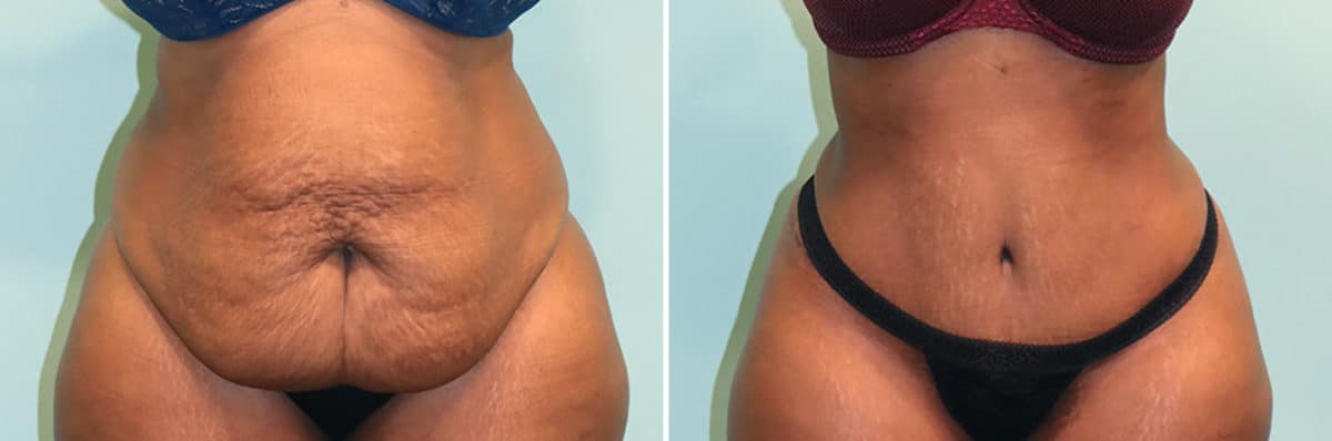 Before and after Tummy Tuck by Dr. Shervin Naderi, Patient 24870