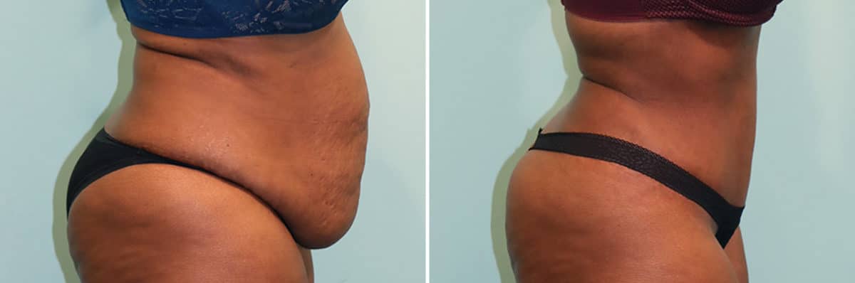 Before and after Tummy Tuck by Dr. Shervin Naderi, Patient 24870