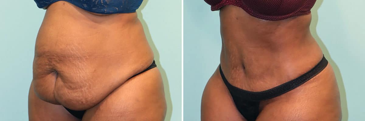 Before and after Tummy Tuck by Dr. Shervin Naderi, Patient 24870