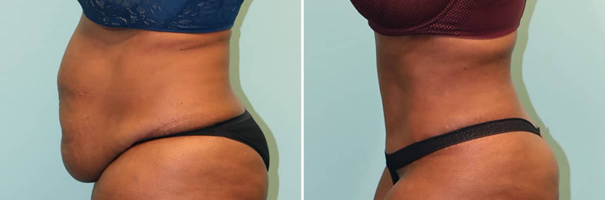 Before and after Tummy Tuck by Dr. Shervin Naderi, Patient 24870