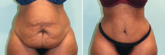 Before and after Tummy Tuck by Dr. Shervin Naderi, Patient 24870